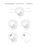 METHOD OF MANUFACTURING A MABE PEARL diagram and image