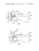 INTERSPINOUS DYNAMIC STABILIZATION SYSTEM WITH ANISOTROPIC HYDROGELS diagram and image