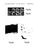 DEVICE FOR THE REGENERATION AND PREVENTION OF DEGENERATION OF THE CARTILAGINOUS TISSUE AND SUBCHRONDRAL BONE AND THE PROLIFERATION OF CHONDROCYTES BY MEANS OF A PULSED ELECTROMAGNETIC FIELD diagram and image