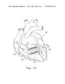 VENTRICULAR INFARCT ASSIST DEVICE AND METHODS FOR USING IT diagram and image