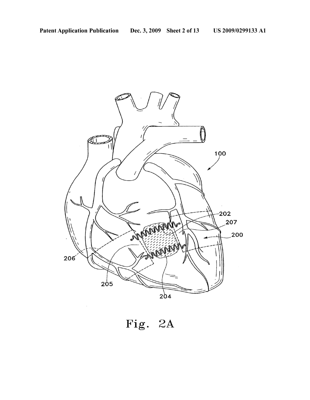 VENTRICULAR INFARCT ASSIST DEVICE AND METHODS FOR USING IT - diagram, schematic, and image 03