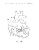 VENTRICULAR INFARCT ASSIST DEVICE AND METHODS FOR USING IT diagram and image