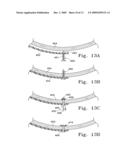 VENTRICULAR INFARCT ASSIST DEVICE AND METHODS FOR USING IT diagram and image