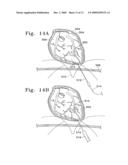 VENTRICULAR INFARCT ASSIST DEVICE AND METHODS FOR USING IT diagram and image