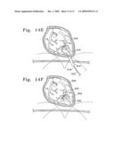 VENTRICULAR INFARCT ASSIST DEVICE AND METHODS FOR USING IT diagram and image