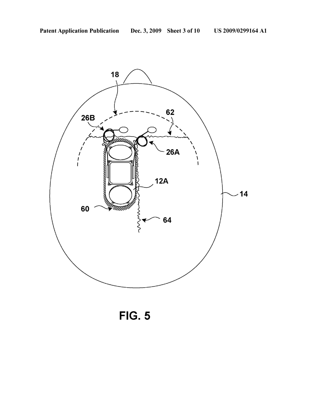 IMPLANTATION OF IMPLANTABLE MEDICAL DEVICE - diagram, schematic, and image 04