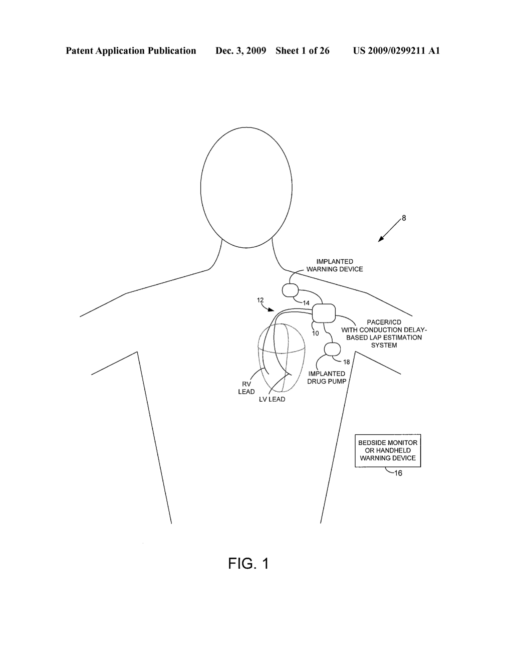 SYSTEM AND METHOD FOR ESTIMATING ELECTRICAL CONDUCTION DELAYS FROM IMMITTANCE VALUES MEASURED USING AN IMPLANTABLE MEDICAL DEVICE - diagram, schematic, and image 02