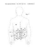 REDUCED-PRESSURE, COMPRESSION SYSTEMS AND APPARATUSES FOR USE ON A CURVED BODY PART diagram and image