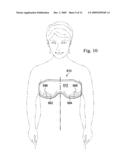 REDUCED-PRESSURE, COMPRESSION SYSTEMS AND APPARATUSES FOR USE ON A CURVED BODY PART diagram and image