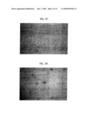 Topical Aminolevulinic Acid-Photodynamic Therapy for the Treatment of Acne Vulgaris diagram and image