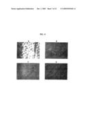 Topical Aminolevulinic Acid-Photodynamic Therapy for the Treatment of Acne Vulgaris diagram and image