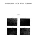 Topical Aminolevulinic Acid-Photodynamic Therapy for the Treatment of Acne Vulgaris diagram and image