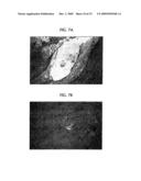 Topical Aminolevulinic Acid-Photodynamic Therapy for the Treatment of Acne Vulgaris diagram and image