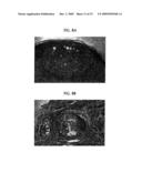 Topical Aminolevulinic Acid-Photodynamic Therapy for the Treatment of Acne Vulgaris diagram and image