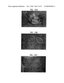 Topical Aminolevulinic Acid-Photodynamic Therapy for the Treatment of Acne Vulgaris diagram and image