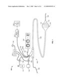 Electrical mapping and cryo ablating with a balloon catheter diagram and image