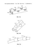 Electrical mapping and cryo ablating with a balloon catheter diagram and image