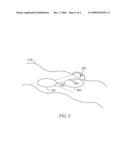 Device, System and Method for In-Vivo Cauterization diagram and image