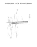 INFLATABLE MEDICAL DEVICES diagram and image