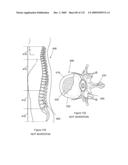 INFLATABLE MEDICAL DEVICES diagram and image