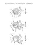 INFLATABLE MEDICAL DEVICES diagram and image