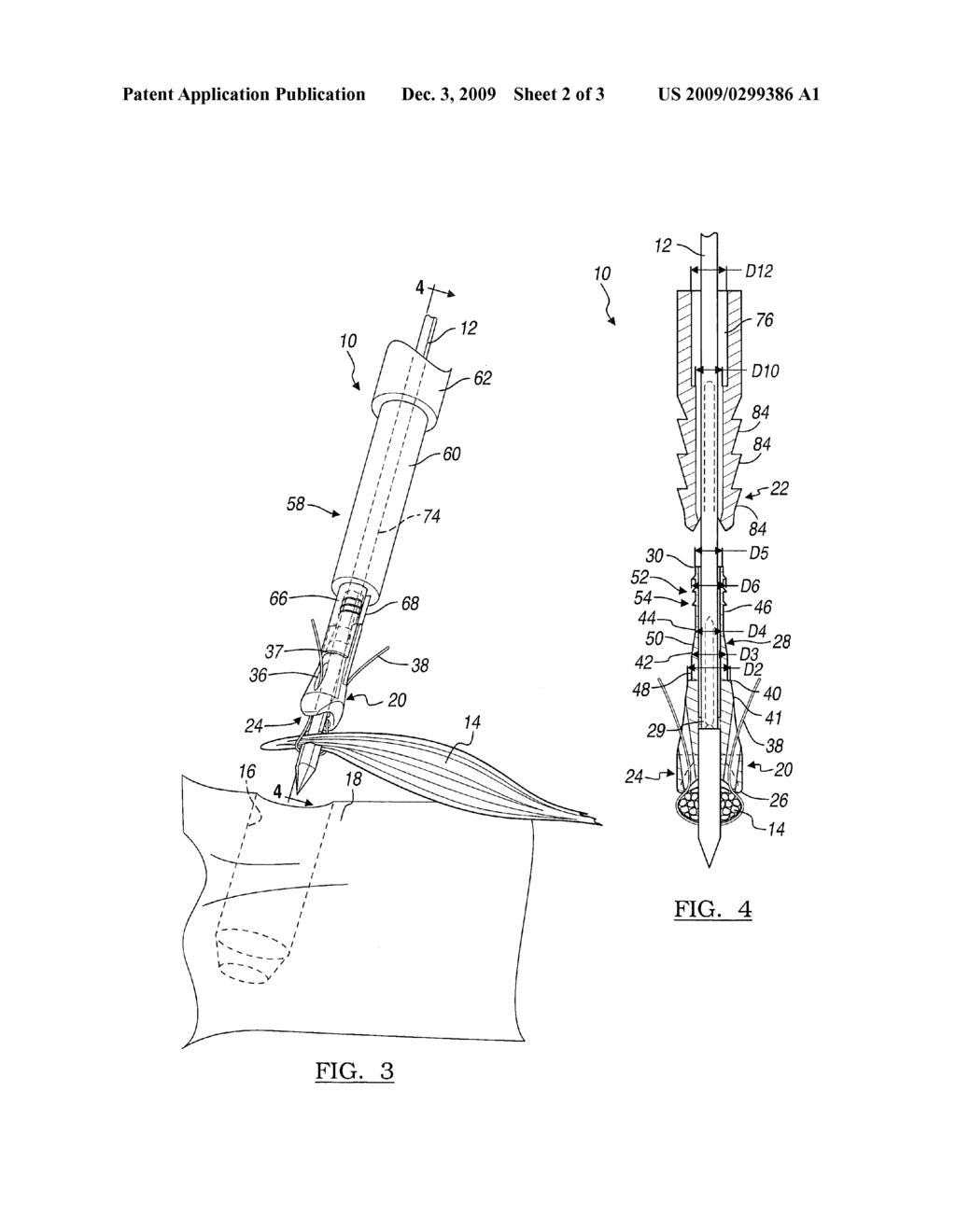 Soft Tissue Rivet and Method of Use - diagram, schematic, and image 03