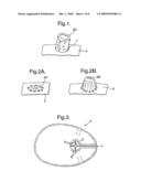 Reinforcement Device diagram and image