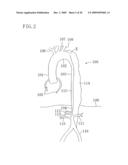 INSTRUMENT FOR DILATING BLOOD CHANNEL AND INSTRUMENT FOR TREATING AORTIC DISSECTION diagram and image