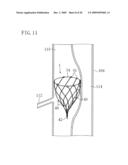 INSTRUMENT FOR DILATING BLOOD CHANNEL AND INSTRUMENT FOR TREATING AORTIC DISSECTION diagram and image