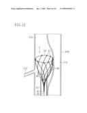 INSTRUMENT FOR DILATING BLOOD CHANNEL AND INSTRUMENT FOR TREATING AORTIC DISSECTION diagram and image