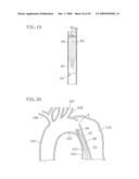 INSTRUMENT FOR DILATING BLOOD CHANNEL AND INSTRUMENT FOR TREATING AORTIC DISSECTION diagram and image