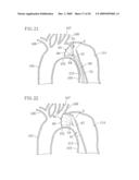 INSTRUMENT FOR DILATING BLOOD CHANNEL AND INSTRUMENT FOR TREATING AORTIC DISSECTION diagram and image