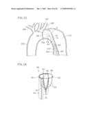 INSTRUMENT FOR DILATING BLOOD CHANNEL AND INSTRUMENT FOR TREATING AORTIC DISSECTION diagram and image