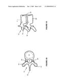 PERCUTANEOUS FACET JOINT FUSION SYSTEM AND METHOD diagram and image