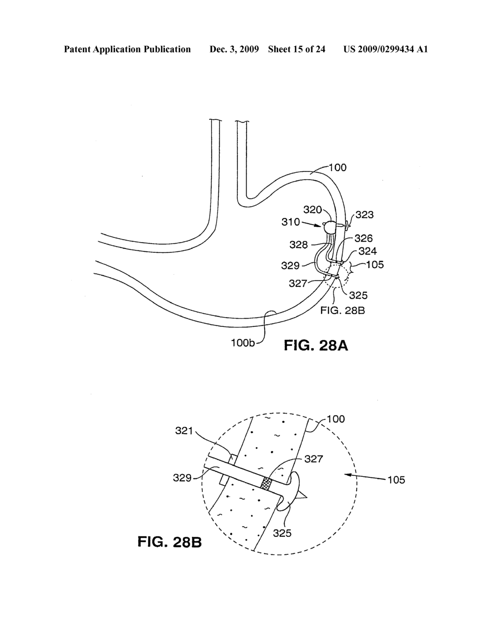 Endoscopic System For Attaching a Device to a Stomach - diagram, schematic, and image 16