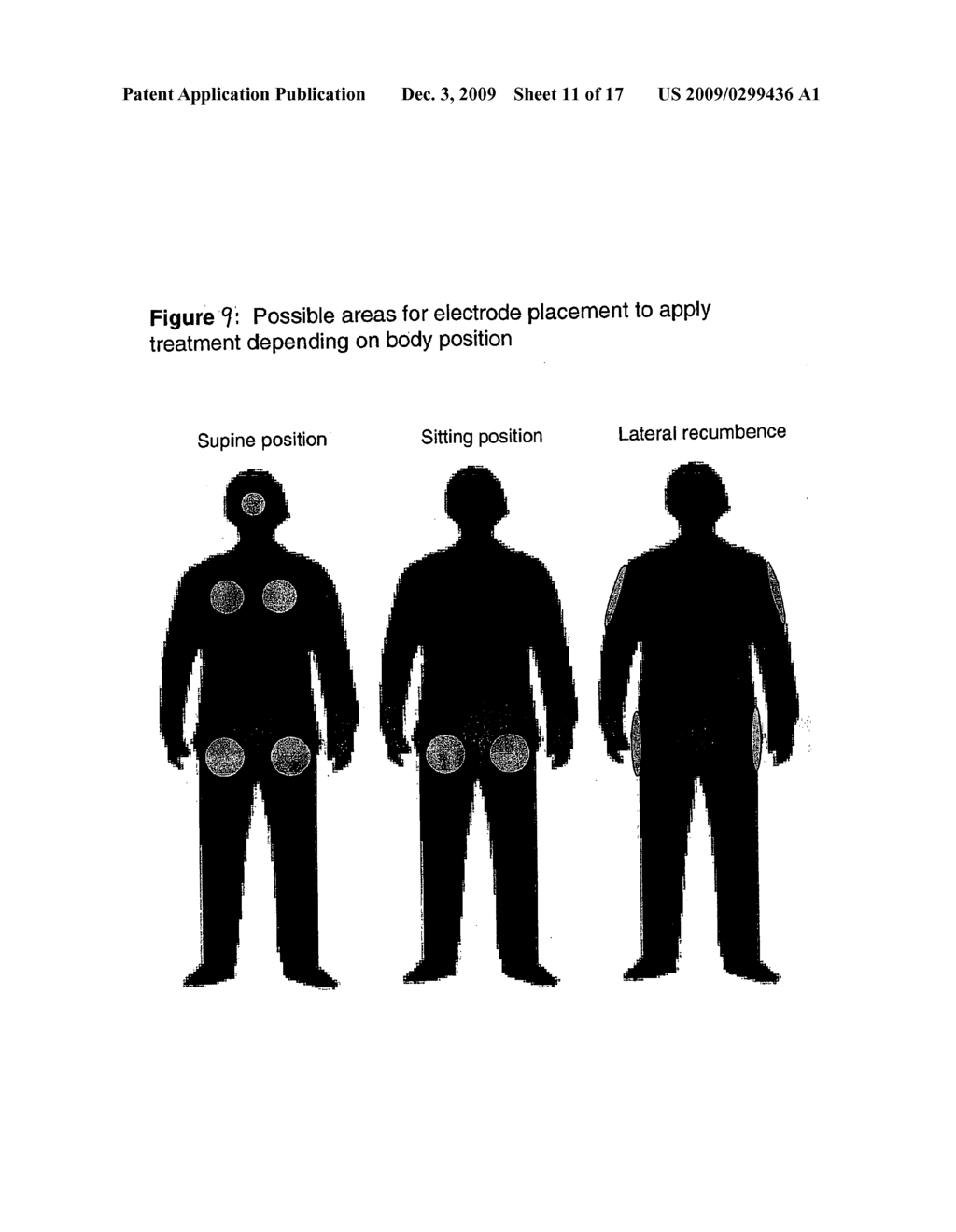 MITIGATION OF PRESSURE ULCERS USING ELECTRICAL STIMULATION - diagram, schematic, and image 12