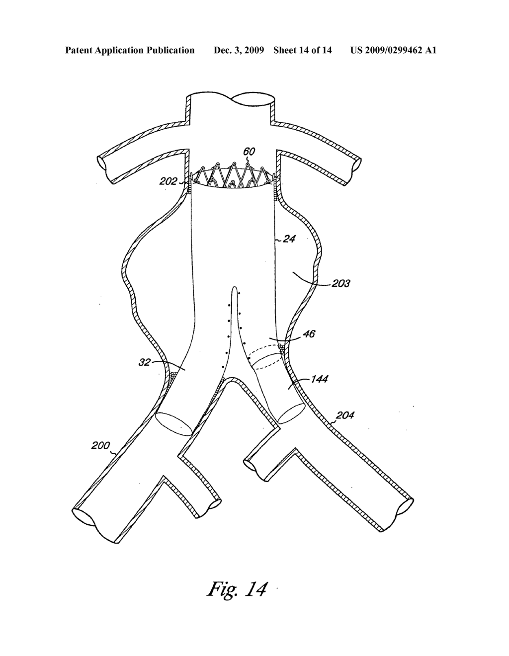 ENDOVASCULAR GRAFT INCLUDING SUBSTRUCTURE FOR POSITIONING AND SEALING WITHIN VASCULATURE - diagram, schematic, and image 15