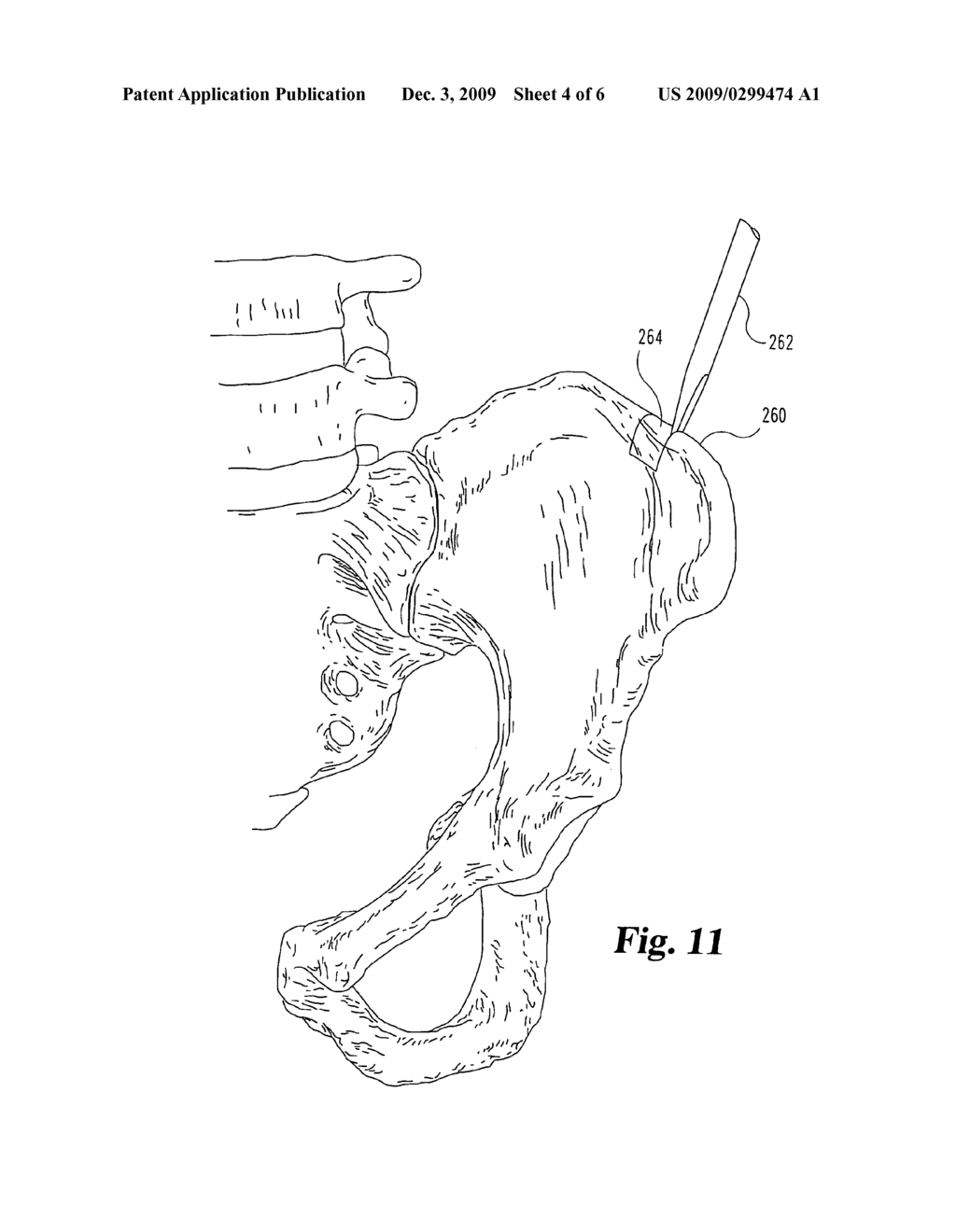 Impacted orthopedic support implant - diagram, schematic, and image 05