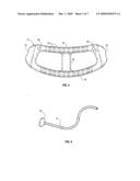 SUTURE GUIDED IMPLANT diagram and image