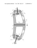 SUTURE GUIDED IMPLANT diagram and image