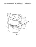 SUTURE GUIDED IMPLANT diagram and image