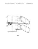 SUTURE GUIDED IMPLANT diagram and image