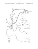 METHODS AND APPARATUS FOR NON-INVASIVE IMPLANTABLE PRESSURE SENSOR CALIBRATION diagram and image