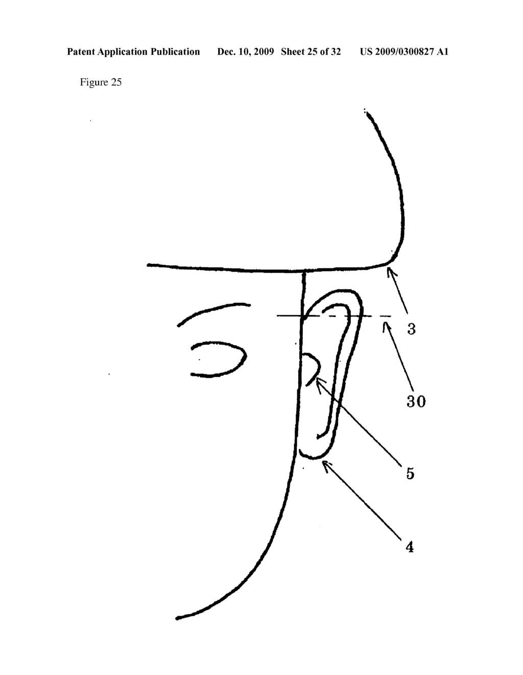 DEVICE REDUCING WIND NOISE - diagram, schematic, and image 26