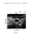 REDUCTION OF ECHO DECORRELATION FACILITATING MOTION ESTIMATION diagram and image