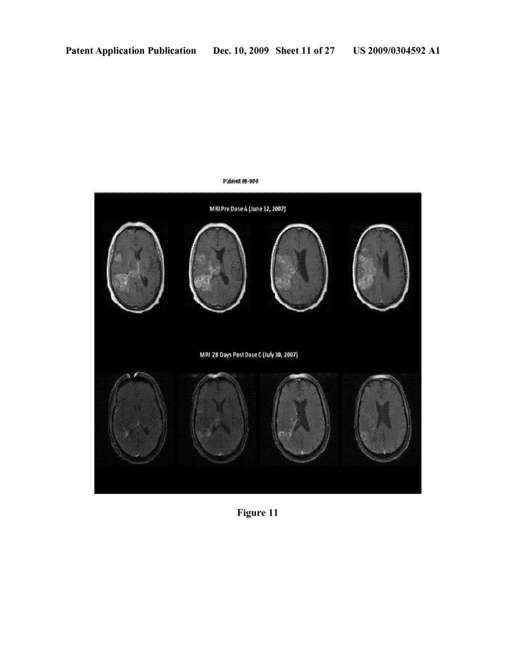 TREATMENT OF METASTATIC TUMORS - diagram, schematic, and image 12