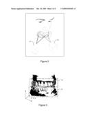 Method Of Designing Custom Articulator Inserts Using Four-Dimensional Data diagram and image