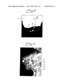 IMPLANT ARRANGEMENT diagram and image