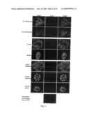 USE OF AN INTERLEUKIN 1 RECEPTOR ANTAGONIST AND/OR PYRROLIDINEDITHIOCARBAMATE FOR THE TREATMENT OR PROPHYLAXIS OF TYPE 2 DIABETES diagram and image