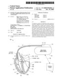 SENSING VECTOR CONFIGURATION IN ICD TO ASSIST ARRHYTHMIA DETECTION AND ANNOTATION diagram and image